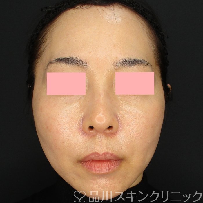 症例NO.73634のAFTER写真