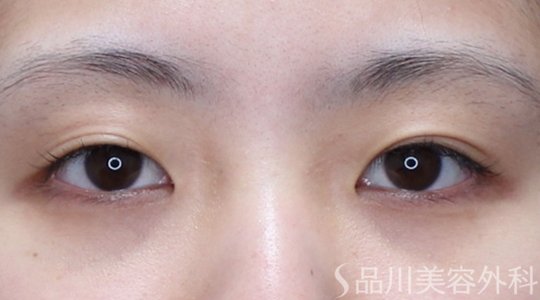 症例NO.71720のBEFORE写真