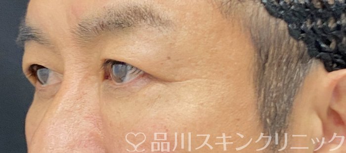 症例NO.74818のAFTER写真
