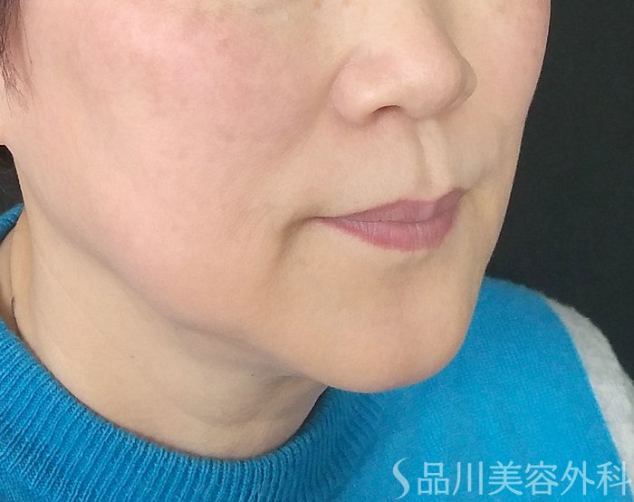 症例NO.69342のBEFORE写真