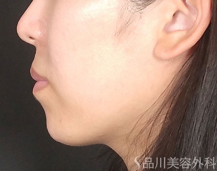 症例NO.64879のAFTER写真