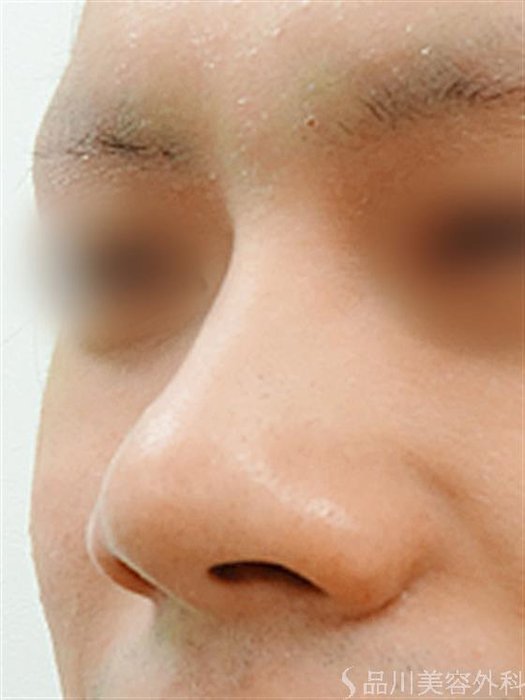 症例NO.23230のBEFORE写真