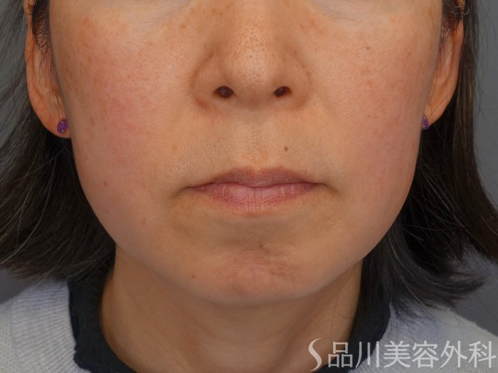 症例NO.72689のBEFORE写真
