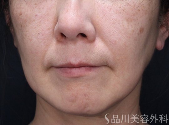症例NO.74016のBEFORE写真
