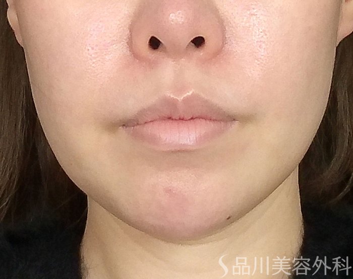 症例NO.69218のBEFORE写真