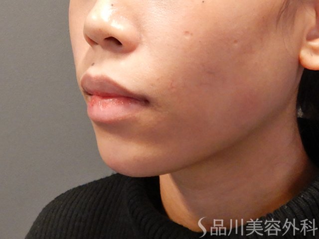 症例NO.73095のAFTER写真