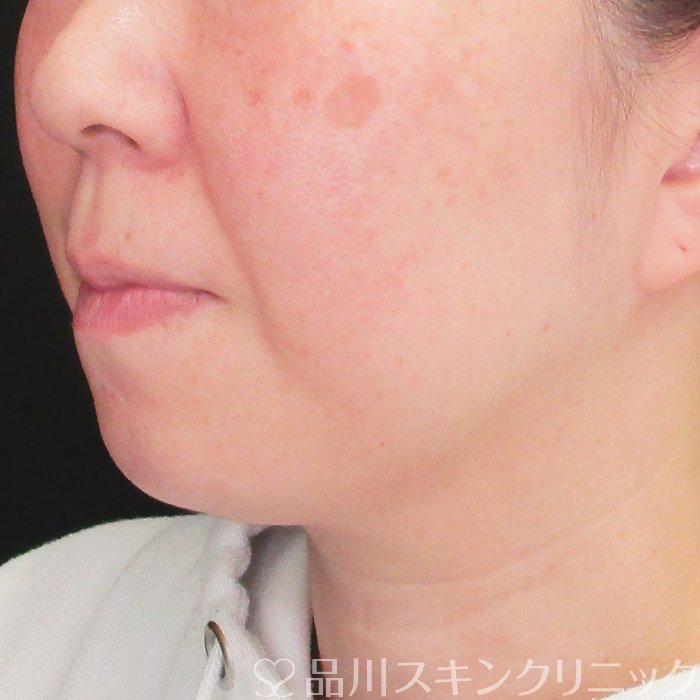 症例NO.73118のBEFORE写真