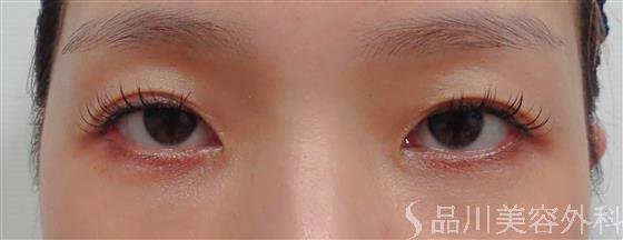 症例NO.60432のAFTER写真