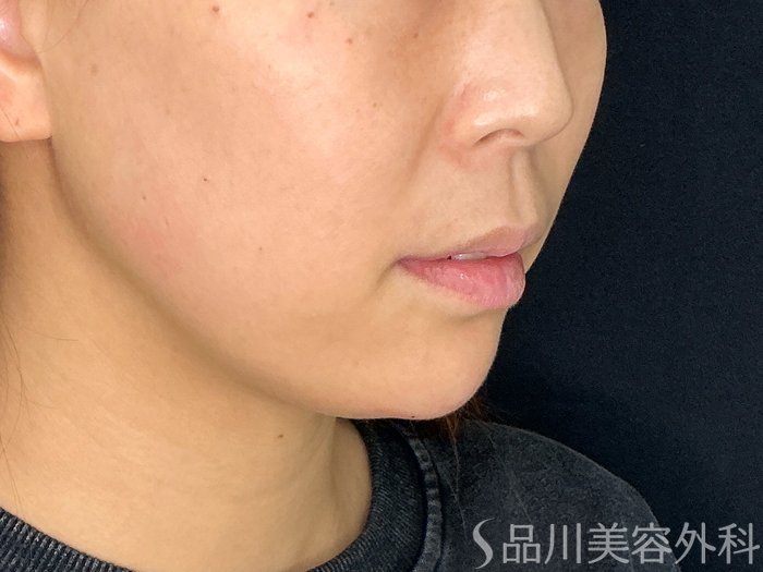 症例NO.72621のAFTER写真