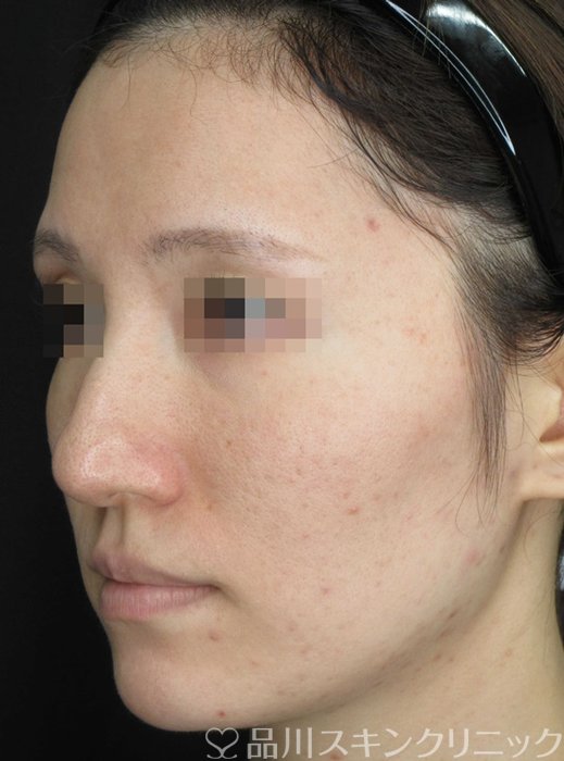 症例NO.69491のBEFORE写真