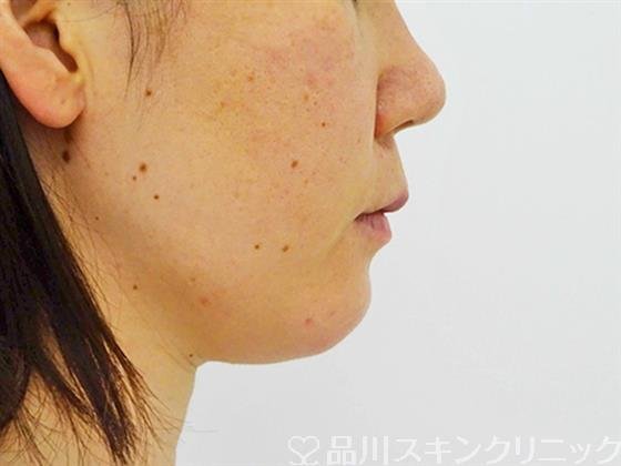 症例NO.49558のAFTER写真