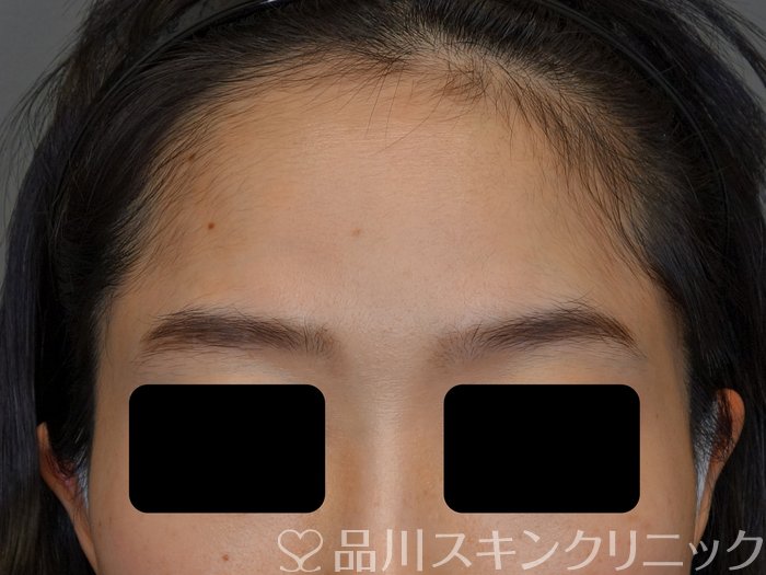症例NO.74090のBEFORE写真