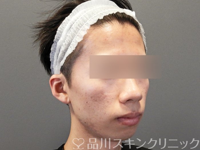 症例NO.65027のBEFORE写真