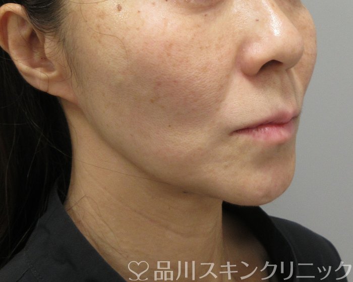 症例NO.73600のBEFORE写真