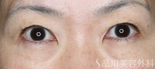 症例NO.74971のBEFORE写真
