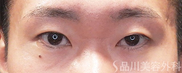 症例NO.72269のBEFORE写真