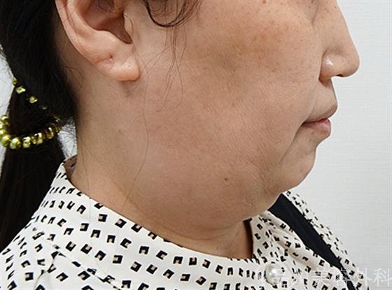 症例NO.61740のBEFORE写真