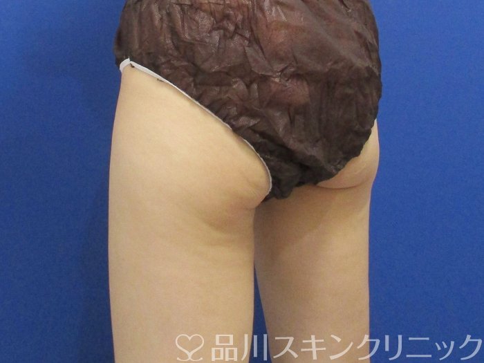 症例NO.71098のAFTER写真