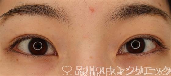 症例NO.65684のAFTER写真