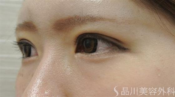 症例NO.14604のAFTER写真