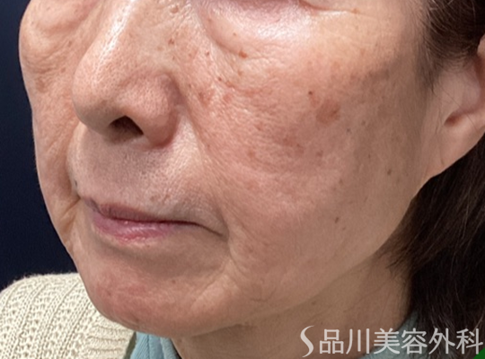 症例NO.73425のAFTER写真