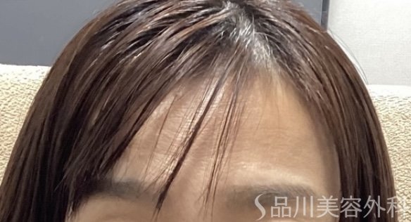 症例NO.68290のBEFORE写真