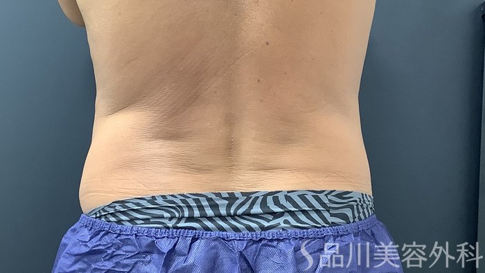 症例NO.75382のAFTER写真