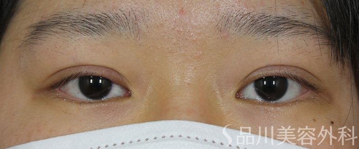 症例NO.71892のAFTER写真