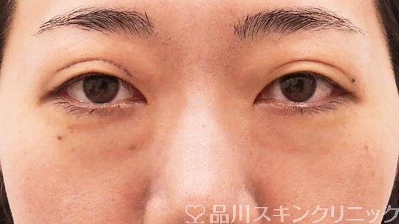 症例NO.61696のBEFORE写真