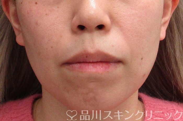 症例NO.70113のBEFORE写真