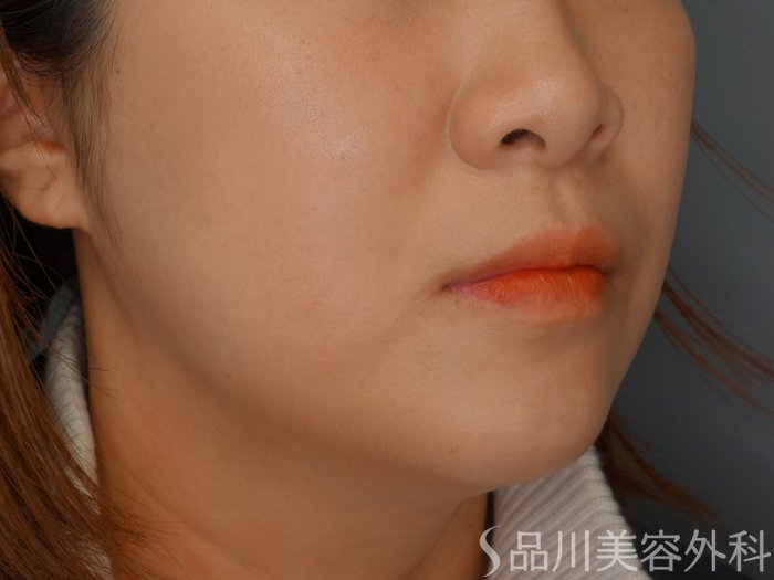 症例NO.73679のAFTER写真