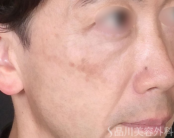 症例NO.70264のBEFORE写真