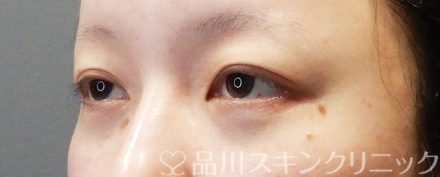 症例NO.74999のBEFORE写真