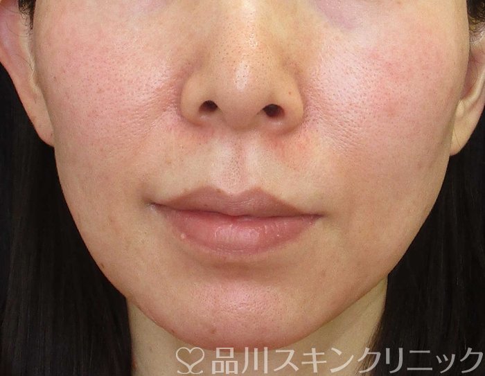 症例NO.65685のBEFORE写真