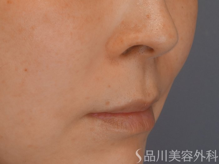 症例NO.69369のAFTER写真