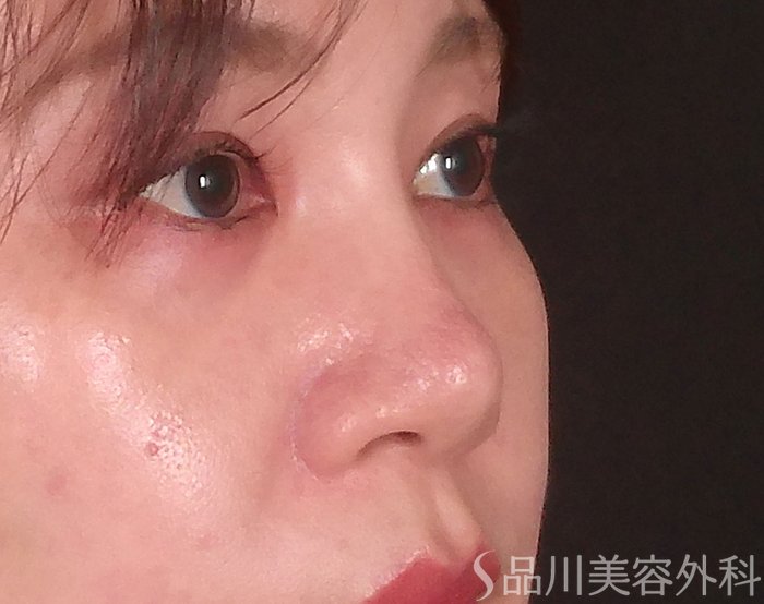 症例NO.69901のBEFORE写真