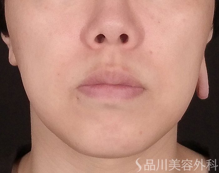 症例NO.70548のBEFORE写真
