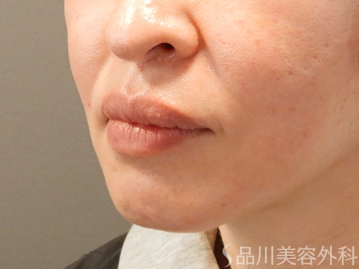 症例NO.69537のBEFORE写真