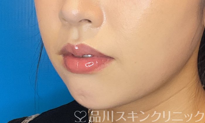 症例NO.74487のBEFORE写真