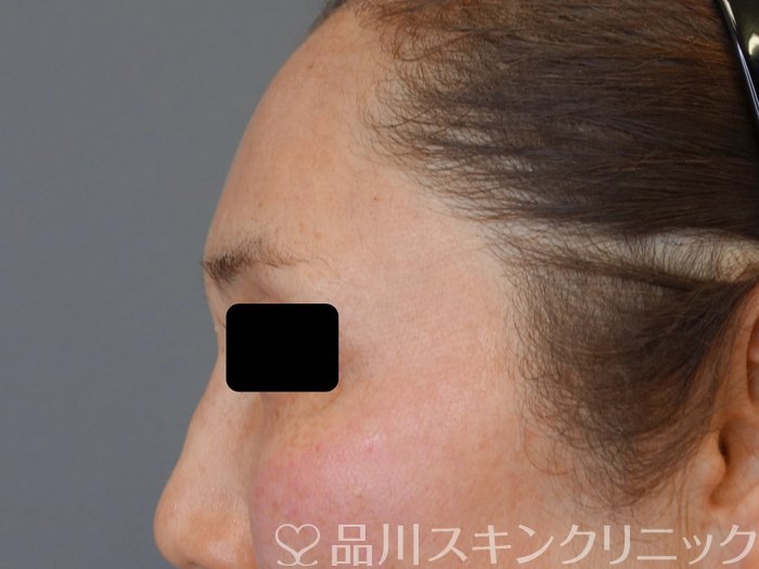 症例NO.73350のAFTER写真