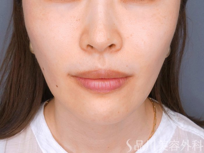 症例NO.73647のBEFORE写真