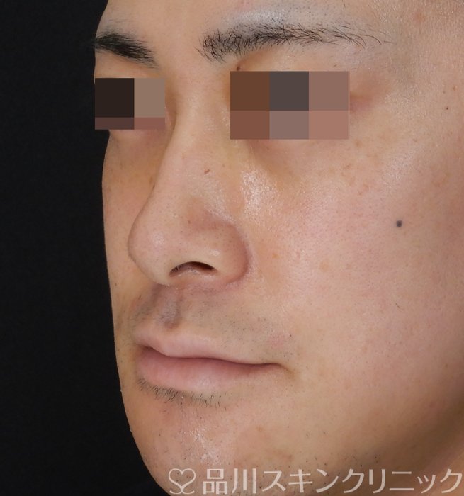 症例NO.65975のBEFORE写真