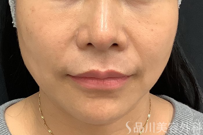 症例NO.73318のBEFORE写真