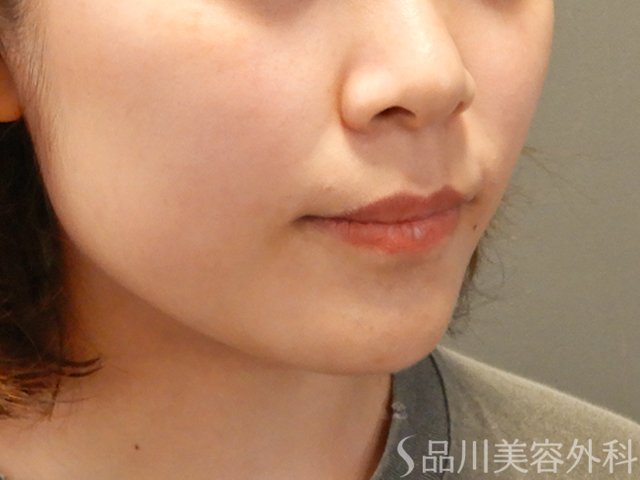 症例NO.71798のBEFORE写真