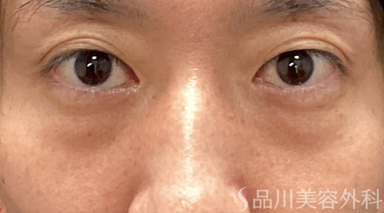 症例NO.74221のAFTER写真