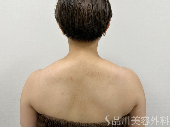 症例NO.73713のAFTER写真