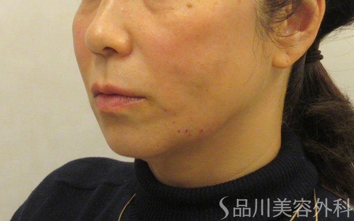 症例NO.72507のAFTER写真