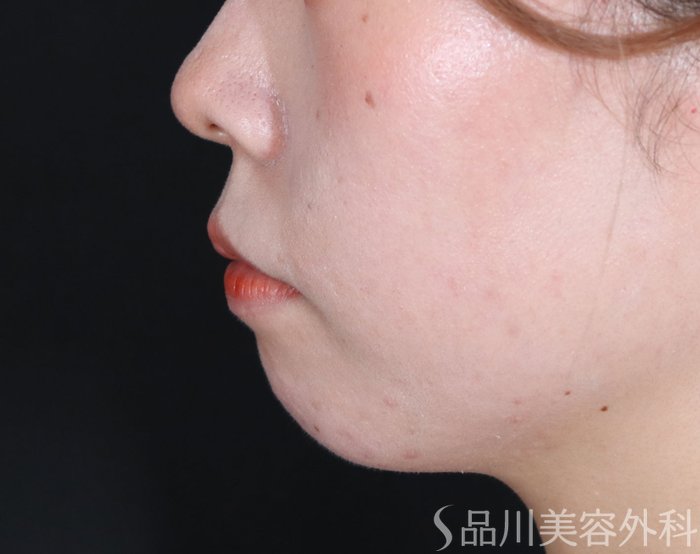 症例NO.71021のBEFORE写真