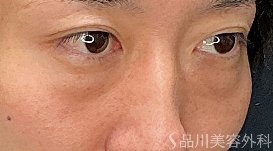 症例NO.74221のBEFORE写真