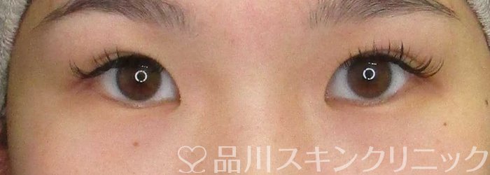 症例NO.69962のBEFORE写真